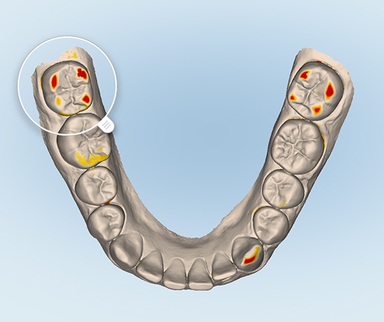 Digital Nu Smile Aligner treatment plan on chairside computer