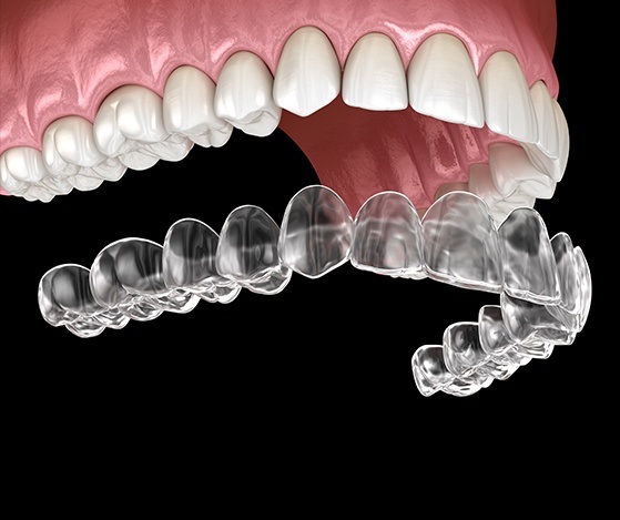 Animated placement of Nu Smile Aligner tray over teeth