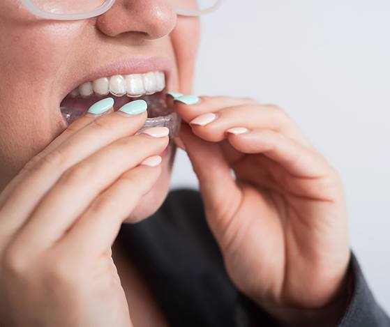 Patient placing her Nu Smile Aligner tray