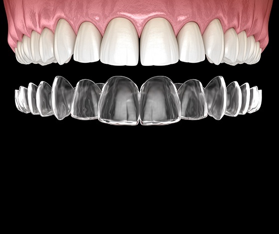 Animated placement of Nu Smile Aligner tray over teeth