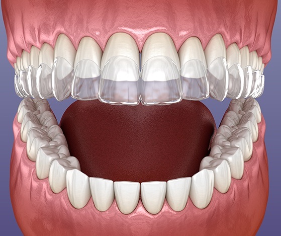 Animated placement of Nu Smile Aligner tray over teeth