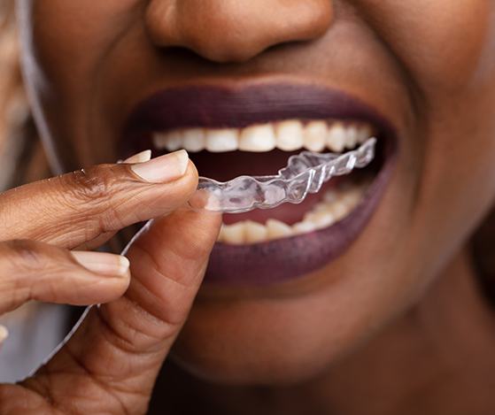 Patient placing Nu Smile Aligner tray