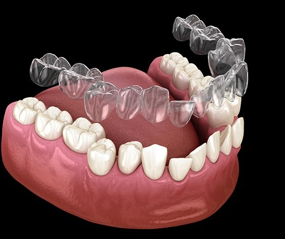 Animated placement of Nu Smile Aligner tray over teeth