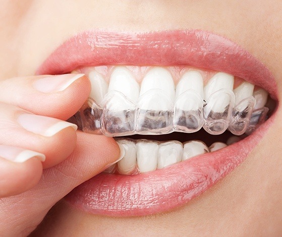 Closeup of patient placing a Nu Smile Aligner tray