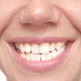 Close-up of crooked teeth in need of clear aligners