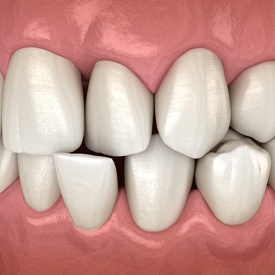 Illustration of crooked teeth with crossbite against dark background