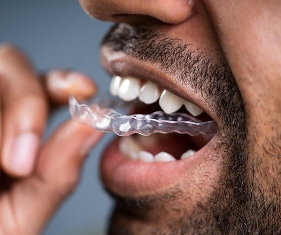 Man placing Nu Smile Aligner tray custom trimmed to fit smile