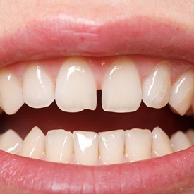 Close-up of smile with a gap between the front teeth