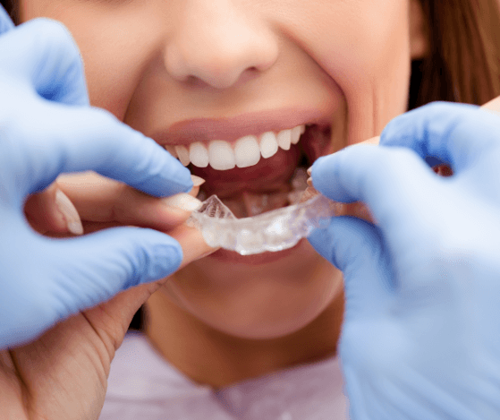 Dentist placing patient's Nu Smile Aligner tray