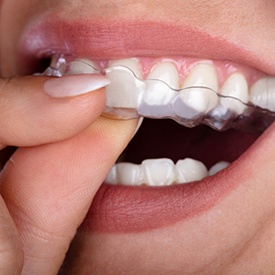 a person putting on Invisalign aligners in Eatontown