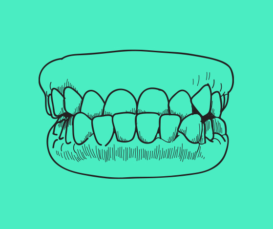 Animated smile with underbite