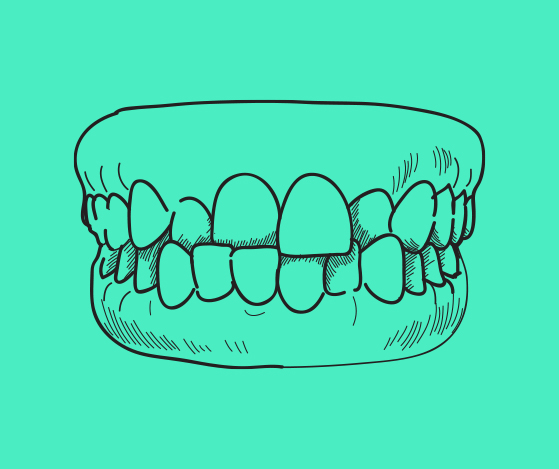 Animated smile with crossbite