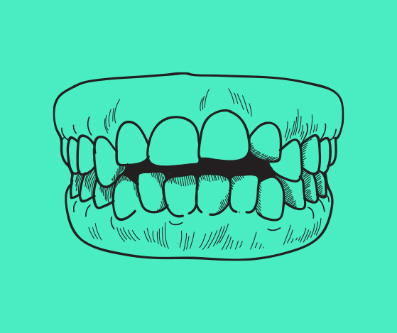 Animated smile with open bite between teeth