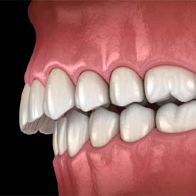 Side view illustration of overbite against dark background