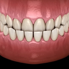 Illustration of underbite, a type of malocclusion that Nu Smile Aligners can treat