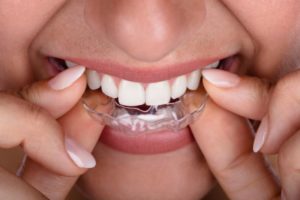 Close-up of woman placing clear aligner on teeth