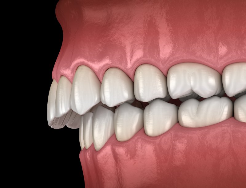 A 3D illustration of an overbite
